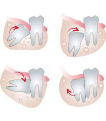 Wisdom Tooth Extraction Treatment In Mohali