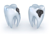 Tooth Decay Cavity Treatment In Chandigarh