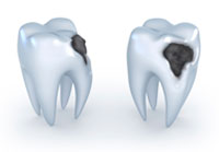 Tooth Decay Cavity Treatment In Chandigarh Tooth Decay Cavity Treatment In Chandigarh