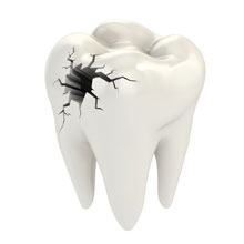 Broken Tooth Treatment In Mohali