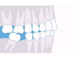 Malaligned Tooth